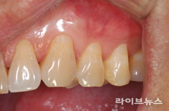 치경부마모증 레진 치료(제공=연세굿데이치과)