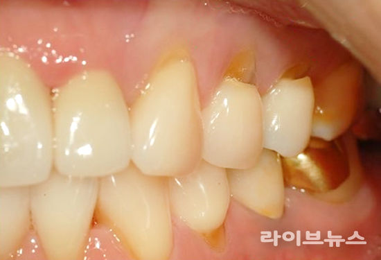 치경부마모증으로 인해 상아질이 드러난 치아상태 (제공=연세굿데이치과)